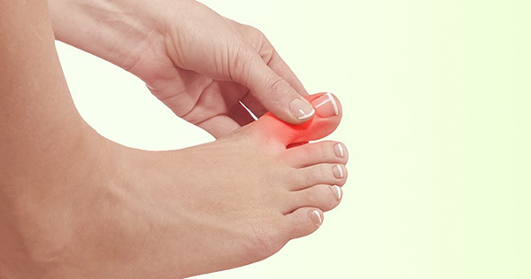 Gicht erkennen &amp; behandeln Ursachen, Symptome, Therapie